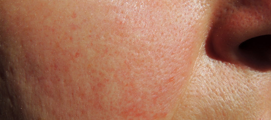 por qué se me pone la cara roja y siento calor